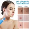 2-In-1 Painless Skin Tag, Mole, And Wart Removal Kit