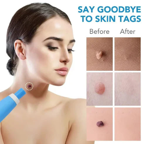 2-In-1 Painless Skin Tag, Mole, And Wart Removal Kit