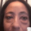 Instant Eye Bag Removal
