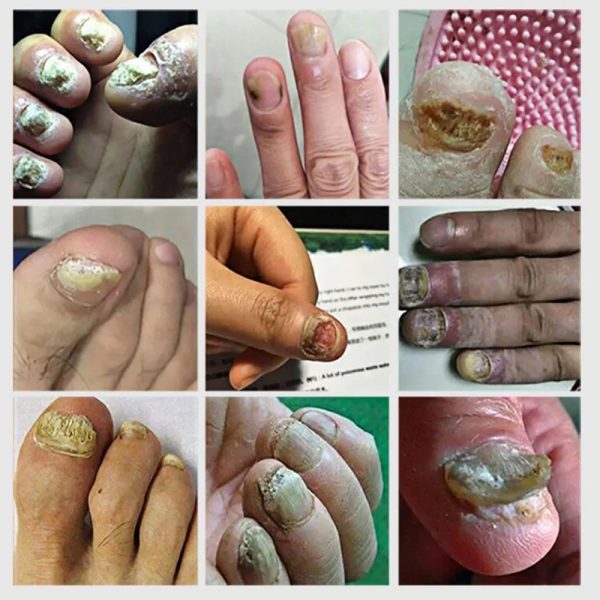 Nail Fungus Defender Serum