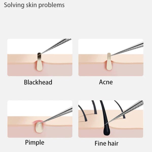Perofessional Facial Blackheads Remover
