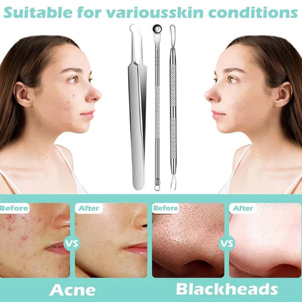 Perofessional Facial Blackheads Remover