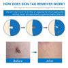 Skin Tag Removal Kit